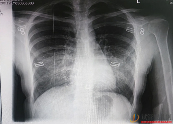 孕婦不能做胸透，一旦接觸了x光射線會導致寶寶畸形概率(圖2)