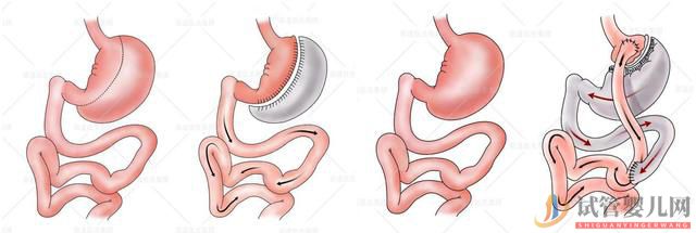 縮胃減肥還會影響生育？想懷孕的媽媽能不能做縮胃(圖1)