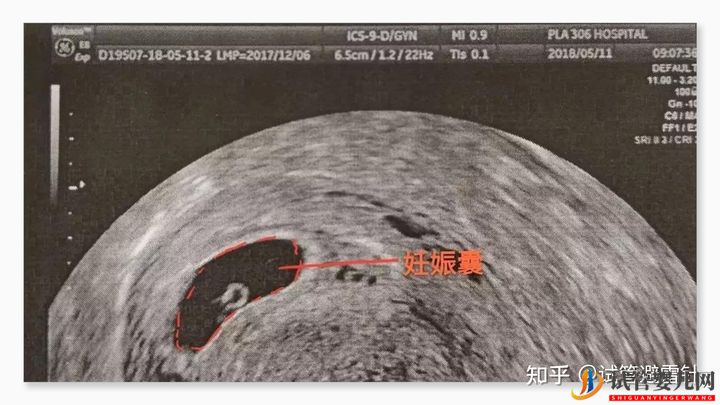 試管嬰兒費用大約多少——最全面的費用詳解(圖2)