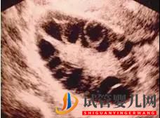 做試管嬰兒用的小卵泡穿刺是什么？適合什么人群？(圖2)