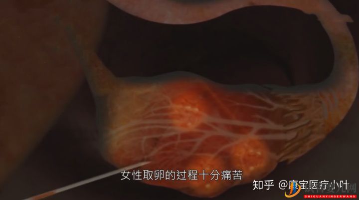 做試管嬰兒有多痛,幾張3D模擬圖,看完全過程后心(圖1)