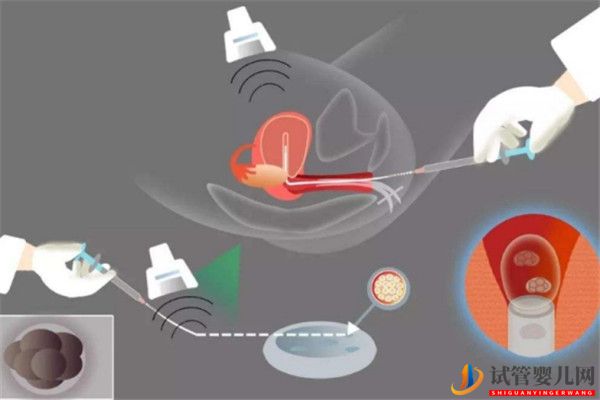 試管嬰兒胚胎移植前需要做哪些準備_移植后需要一直臥床休息么(圖1)