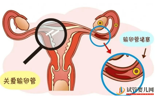 試管嬰兒有哪些適應癥(圖1)