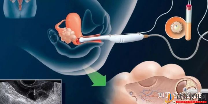 取卵真的特別疼嗎(圖1)