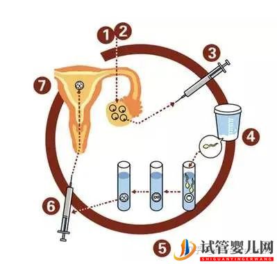 取卵究竟疼不疼呢_聽聽原孕中心的專家們怎么說(圖3)