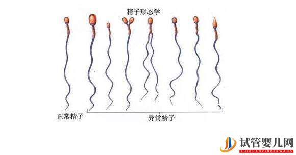 格魯吉亞試管嬰兒精子畸形可以做試管嬰兒嗎？(圖1)