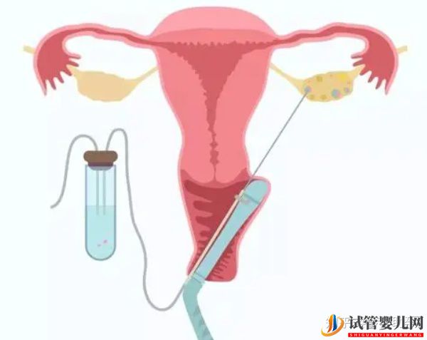 詳解美國第三代試管嬰兒流程(圖4)
