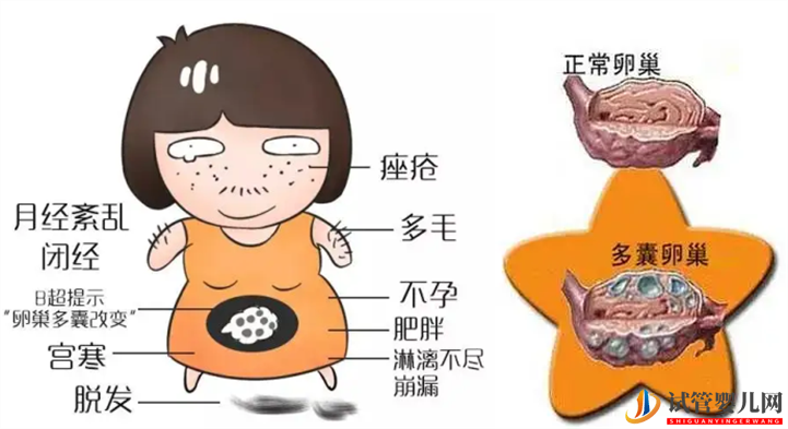 多囊卵巢想懷孕教你三招 如何改善卵巢問題(圖1)