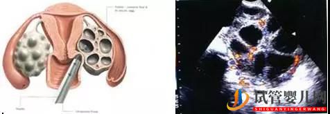 AMH能預(yù)測(cè)試管嬰兒成功嗎?(圖1) AMH能預(yù)測(cè)試管嬰兒成功嗎?(圖1)