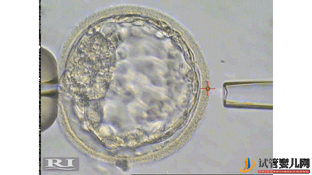 國內外三代試管,技術成熟安全嗎(圖2)