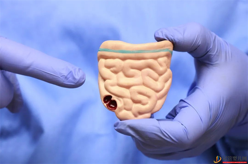 結直腸癌發病年輕化，如何篩查？(圖1)