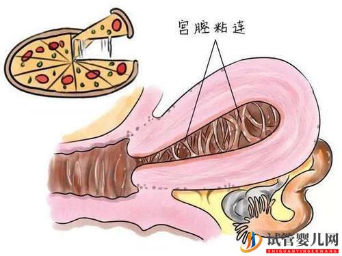 子宮粘連可以做試管嬰兒嗎？成功率高不高？(圖1)