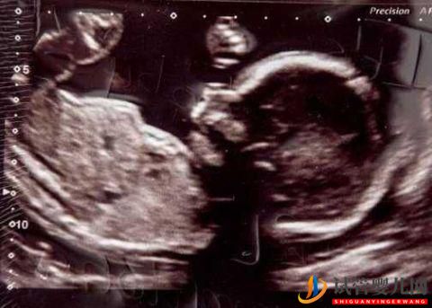 48歲女子努力懷孕23年不成,借高利貸做試管嬰成功,稱不后悔(圖2)