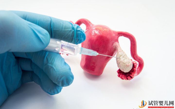 試管嬰兒網(wǎng):如何治療好多囊卵巢綜合癥一般通過以下3種方式可治(圖1) 如何治療好多囊卵巢綜合癥一般通過以下3種方式可治(圖1)