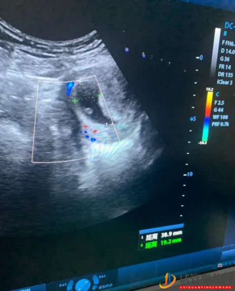 我的三代試管成功之路,重點(diǎn)說(shuō)說(shuō)三甲醫(yī)院試管綠通預(yù)...(圖5)