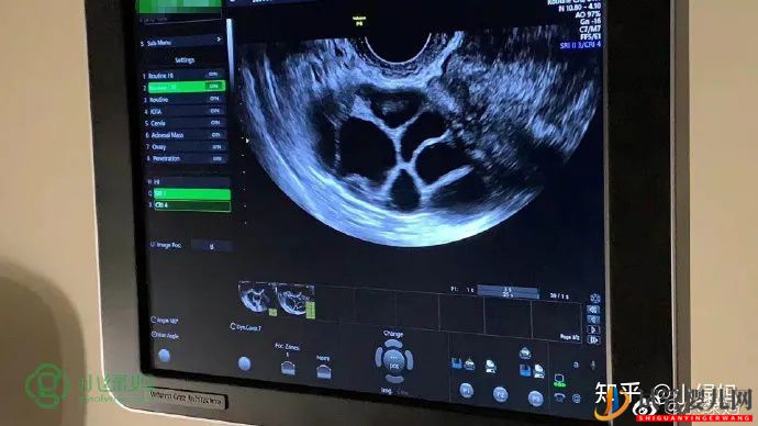 美國試管可以做雙胞胎嗎風險大不大(圖1)