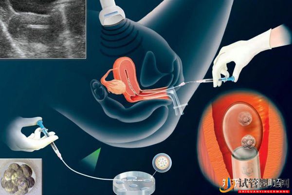 美國試管胚胎移植幾個最好呢(圖2)