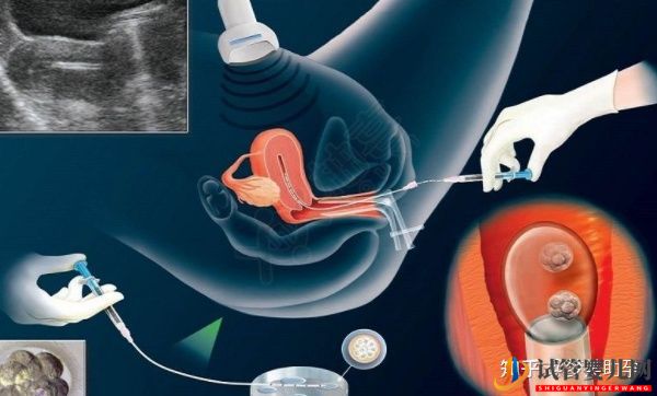 赴美試管嬰兒整個過程需要多長時間(圖3)