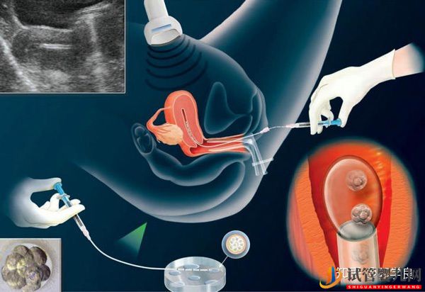 美國試管嬰兒技術正解-常見的4個問題解讀(圖5)
