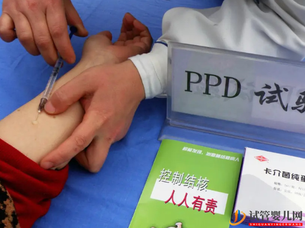 試管做結(jié)核菌測(cè)試的必要性(圖1)