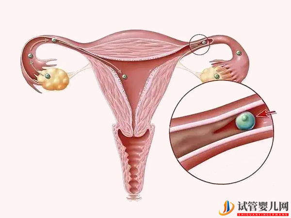 輸卵管通而不暢想做試管得先做手術(圖1)
