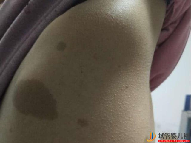 神經纖維瘤咖啡斑患者可以做試管生健康孩子嗎？(圖1)