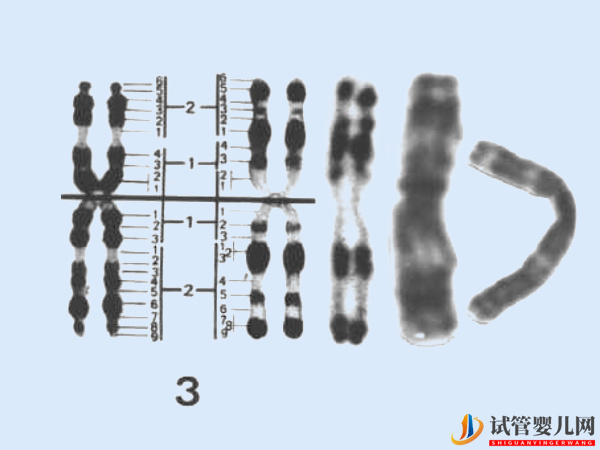 3號染色體異常會怎樣 - 基因微缺失、微重復相關病癥導航(圖1)
