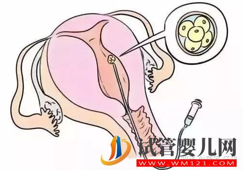 云浮試管嬰兒有關“胚胎移植”的問題解答(圖1)