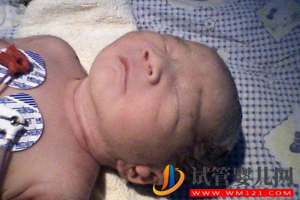 盤點常見26種基因遺傳疾病，絕大部分目前無法治好(圖2)