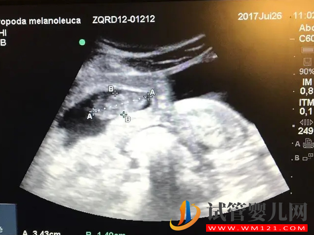 四維彩超數據和圖片看男女超準，這些看男女小技巧全教給你(圖2)