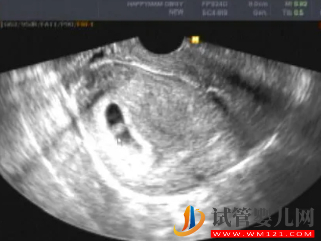 孕囊大小與孕周正常對照表，50天孕囊在范圍就無須擔心(圖1)