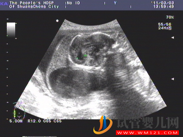 孕期胎兒畸形的10大征兆早知道：下腹痛、流血需及時檢查(圖1)