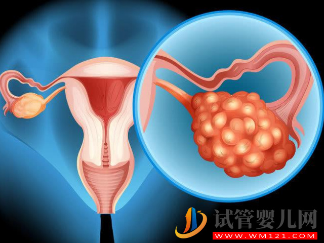 多囊做試管真不是利大于弊，看看這些優劣勢就知道了(圖2)