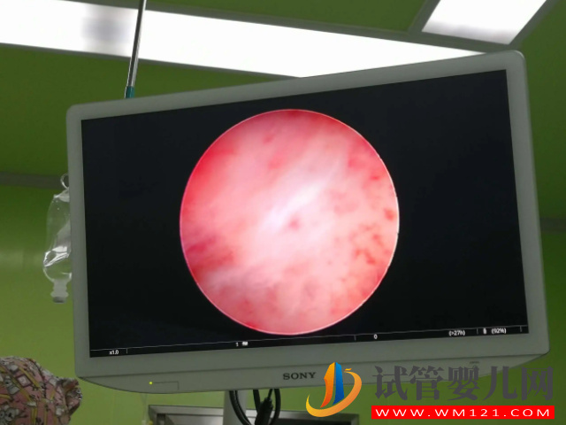 試管移植前這4類人群必做宮腔鏡，能大大提升成功率(圖2)