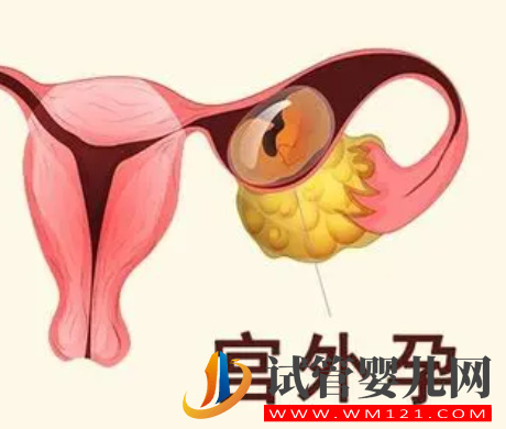 試管宮外孕的幾率占多少(圖1)
