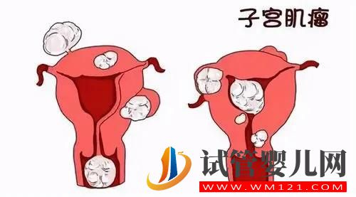 什么是子宮肌瘤？(圖1)