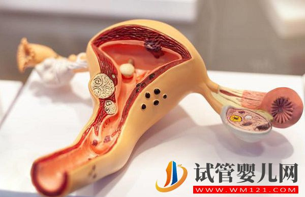 子宮腺肌癥打達(dá)菲林頻率有講究，效果好不好看看就知道(圖1)