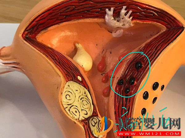 子宮腺肌癥打達(dá)菲林頻率有講究，效果好不好看看就知道(圖3)