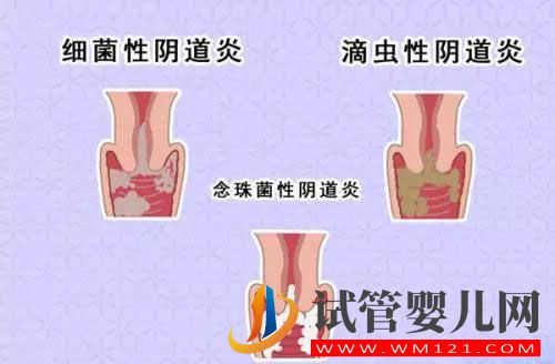 90%的女生都得過陰道炎？到底是怎么來的？(圖4)