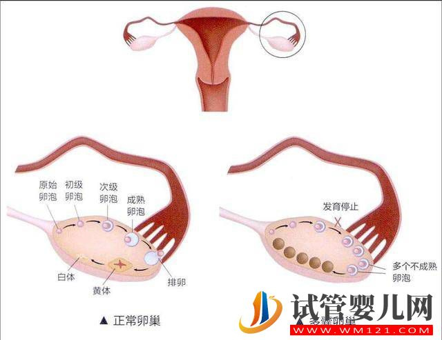 多囊卵巢綜合征是怎樣的一種疾病？(圖1)