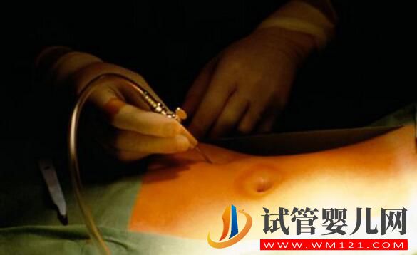 做試管嬰兒取多少個(gè)卵子合適？(圖3)