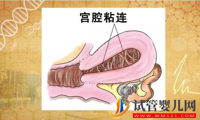 宮內粘連會影響到試管嬰兒嗎？(圖1)