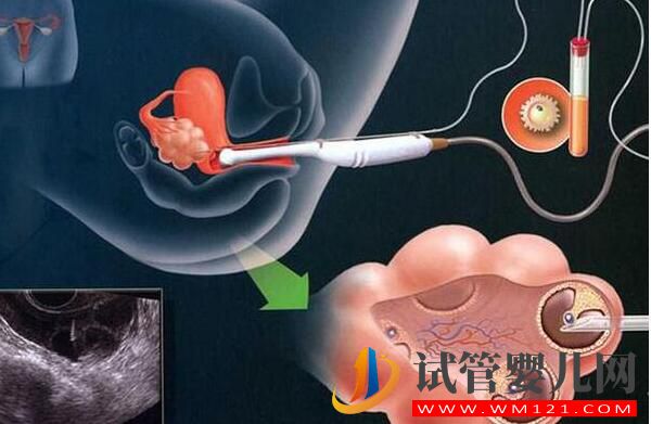 做試管嬰兒,大齡女性如何選擇促排方案?(圖2) 做試管嬰兒,大齡女性如何選擇促排方案?(圖2)