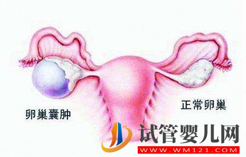 左側卵巢被割除、三次試管失敗她該怎么辦？(圖1)