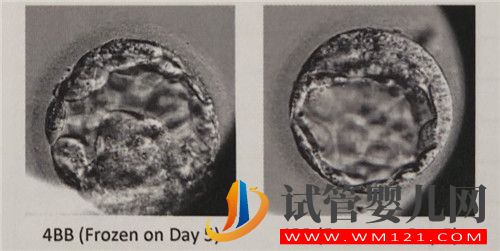 左側卵巢被割除、三次試管失敗她該怎么辦？(圖4)