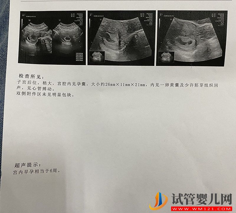 兩次試管都生的是女兒第三次我想要個兒子(圖1)