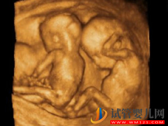 高齡女性通過三代試管做雙胞胎的風險有哪些？(圖1)