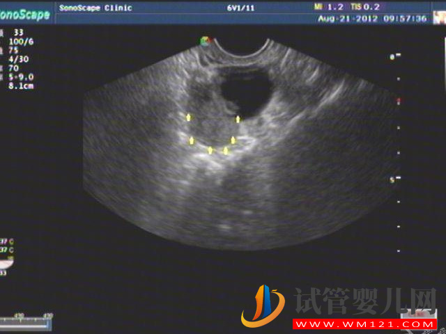 子宮要多大才可以在做試管的時候移植雙胎？(圖2)