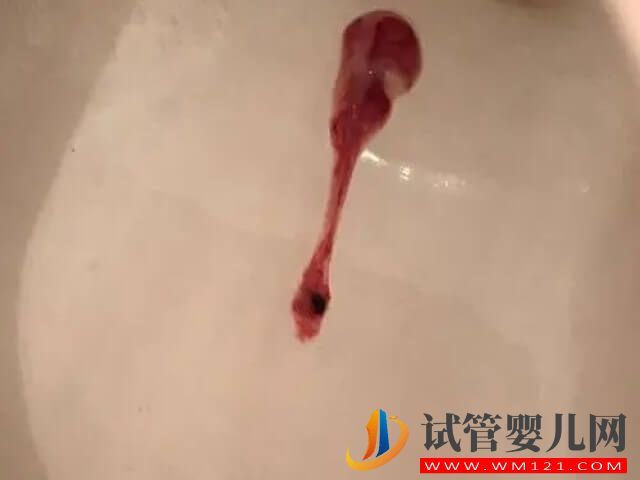 喀什移植第23天晚上突然出少量鮮血能保住嗎？(圖1)