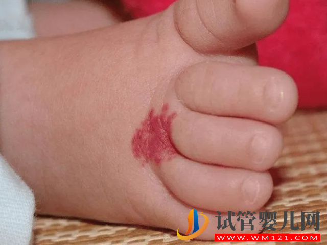 兒童不同位置胎記圖解大全，是福是禍點看看了才知道(圖1)